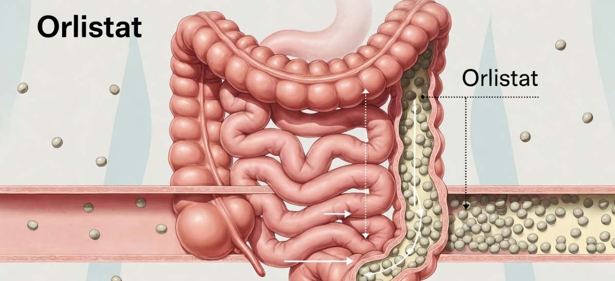 Orlistat for weight management: what to know before using it